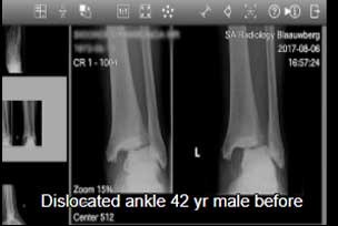 42yr male dislocated ankle