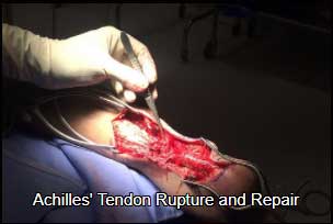 Achilles tendon rupture and repair