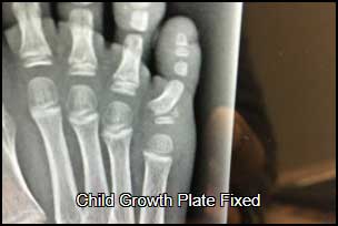 Child growth plate fixed