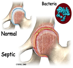 Child hip septic