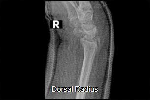 Dorsal radius
