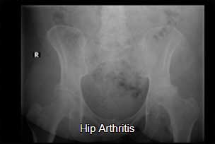 Hip arthritis