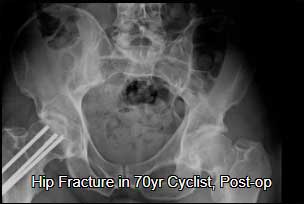 Hip fracture cyclist post op