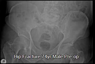 Hip fracture male pre-op
