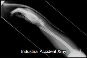 Industrial accident