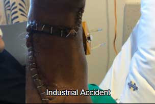 Industrial accident