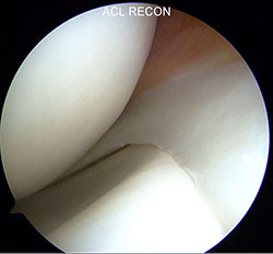 Intact meniscus 2-small