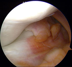 Intact meniscus 2-small