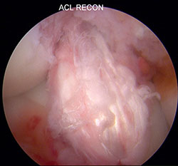 Intact meniscus 2-small
