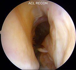 Intact meniscus 2-small