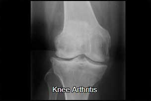 Knee arthritis