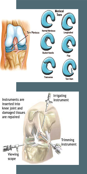 Knee arthroscopy