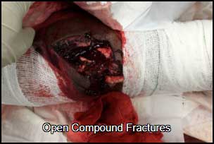 Open compound fractures