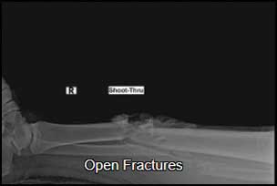 Open fractures