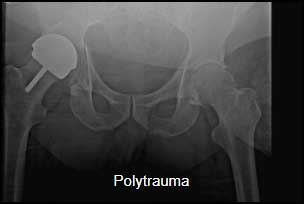 Polytrauma