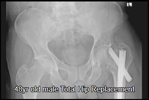 Total hip replacement