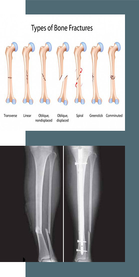 Trauma fracture