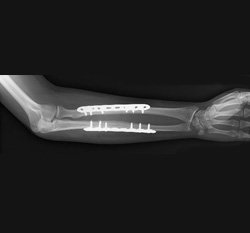 X-ray fracture